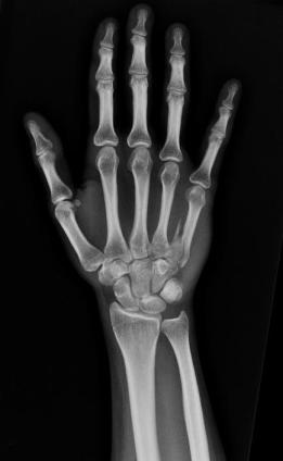 radiografc3ada-de-la-mano