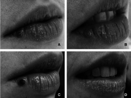 FIG-2-A-Venous-lake-on-the-right-lower-lip-in-a-25-year-old-woman-B-Photograph